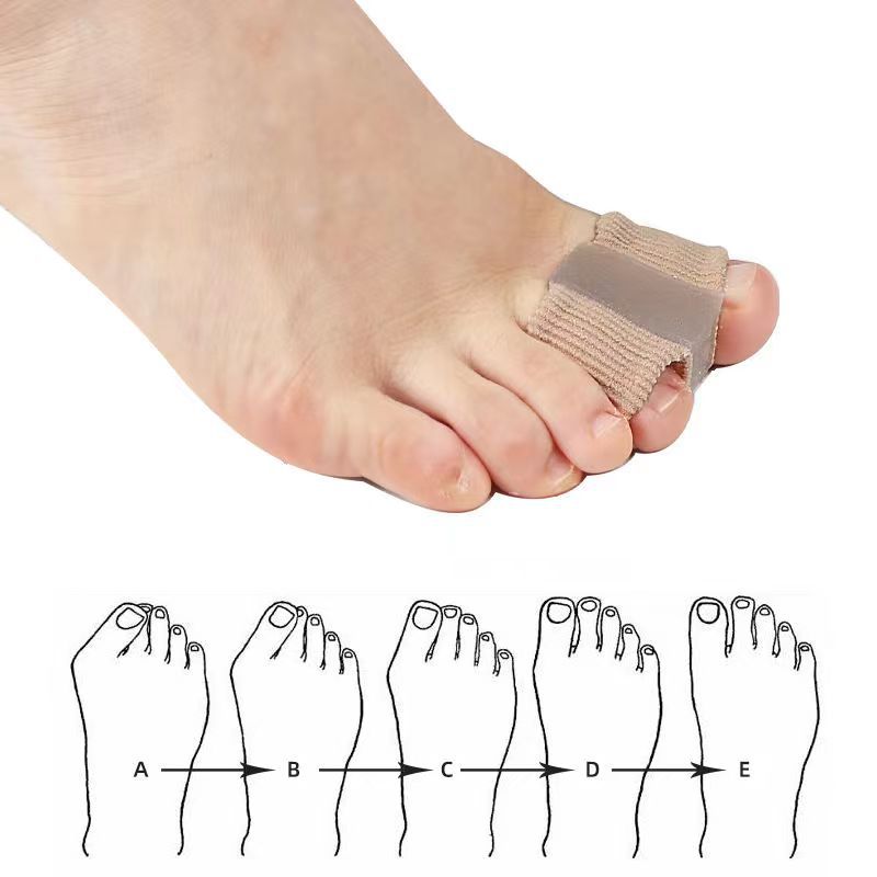 Bunion corrector on a foot with a diagram of foot measurements below.
